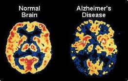 NeuroQuant Brain Scan 