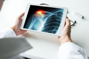 x-ray of broken shoulder on tablet